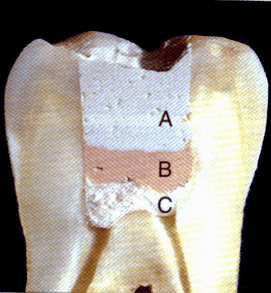 REMOVER ISOLAMENTO A B C