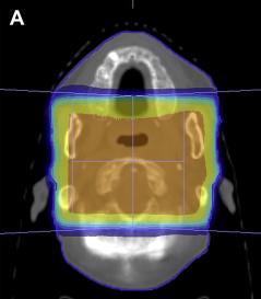 Tratamento - Técnicas Planejamento conformacional tridimensional (3D) GTV: Tumor primário/