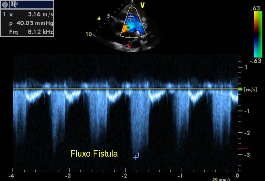 Figura 1 Fluxo da microfístula coronário-pulmonar ao Doppler pulsátil. Velocidade máxima do fluxo diastólico estimada em 3,16 m/s.