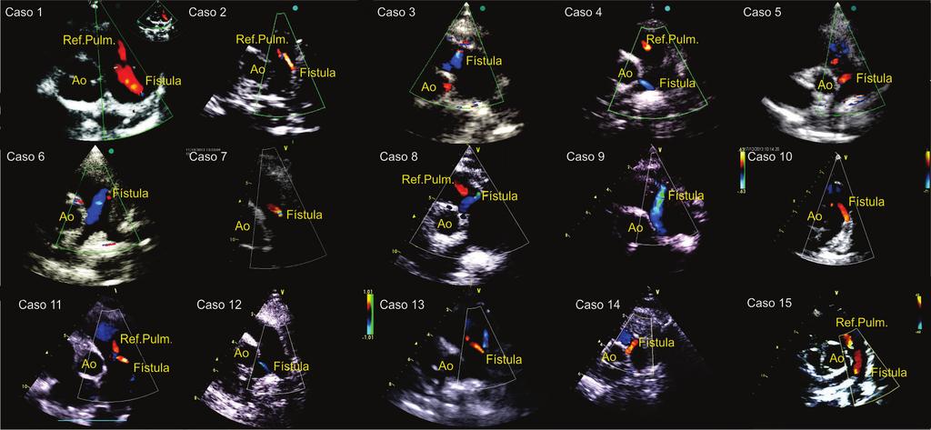 Figura 3 Imagens do ecocardiograma com mapeamento de fluxo em cores dos 15 casos de microfístula coronáriao-pulmonar. Ao: aorta.