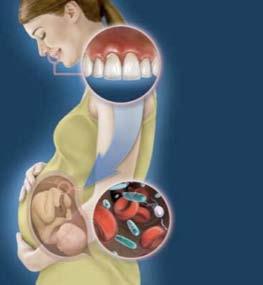 A doença periodontal na gravidez Na gestação, a mulher está mais predisposta a ter a doença periodontal, devido à alta concentração hormonal deste período.