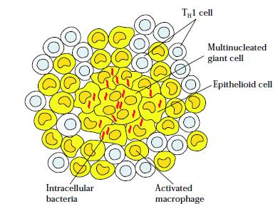 Hipersensibilidade Granulomatosa Células gigantes desestruturam o tecido normal formando nódulos