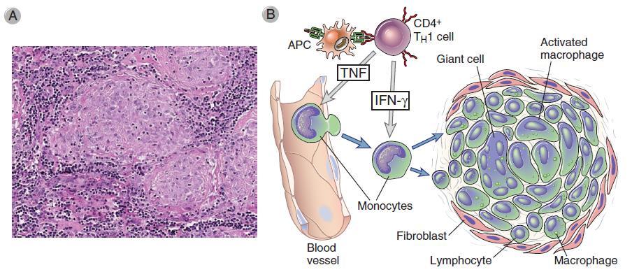 Hipersensibilidade Granulomatosa Macrófagos são as principais células