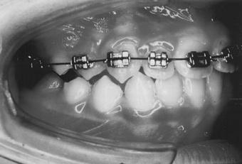 36 resiliência associada à devolução da força com menor intensidade na recuperação da forma permite a correção de maiores desnivelamentos dentários com menor número de trocas dos arcos.