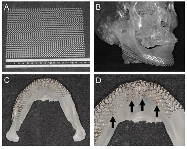 42 Figura 17 - Preparação de uma tela de titânio para mandibulectomia segmentar. (a) Chapa original. (b-d) Tela deformada para coincidir com o modelo de osso craniofacial. Fonte: Yamashita et al.