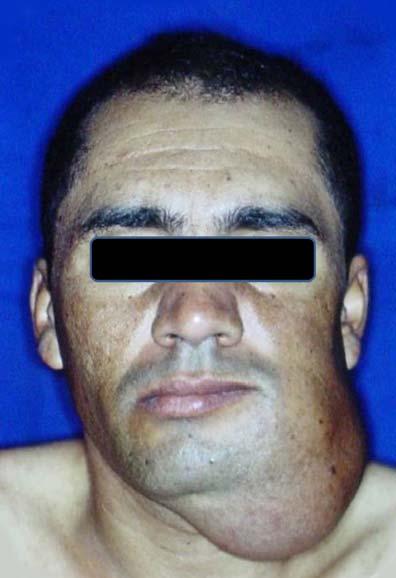 APÊNDICE B - Paciente com ameloblastoma apresentando deformidade facial por aumento de volume acentuado