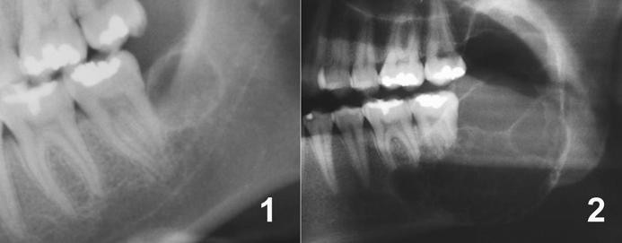 Imagem radiolúcida unilocular e de limites bem definidos em região retromolar.