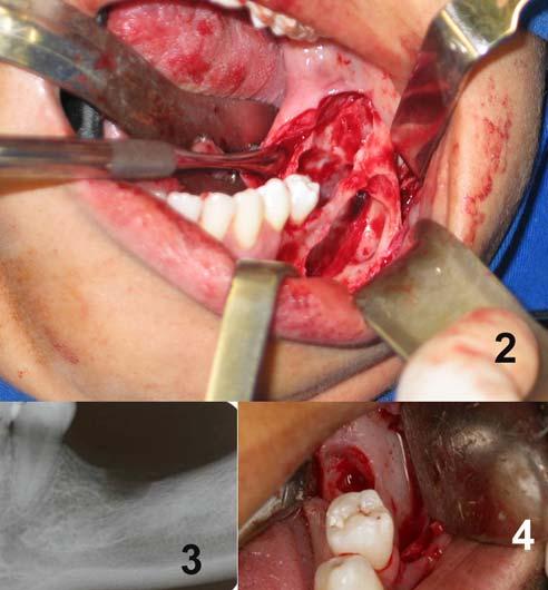 lesão residual); 3.