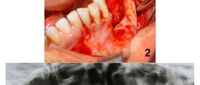 mandibular; 2.