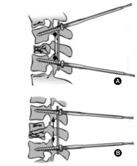 do corpo vertebral durante a realização da ligamentotaxia: lordose seguida de distração ou distração seguida de lordose? Figura 1 - Manobras da ligamentotaxia: lordose (a) e distração (b).