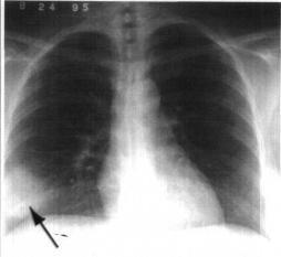 Definição Processo infeccioso do parênquima pulmonar em pacientes não