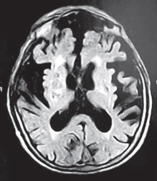 Figura 1: Imagem axial demonstrando atrofia cortical difusa, mas predominando sobre os lobos frontal e temporal, com evidenciação das fissuras