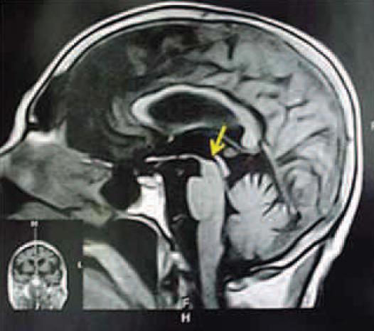 microngiopatia degenerativa periventricular e subcortical.