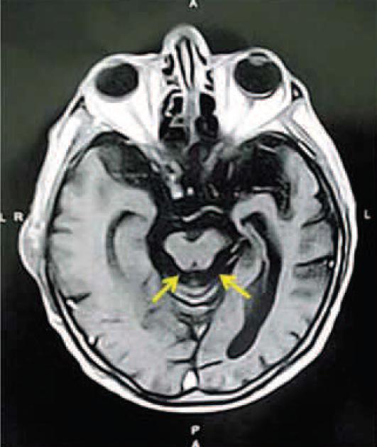 Figura 3: Imagem axial com contraste, mostrando um contorno levemente côncavo da porção lateral do tegmento mesencefálico (setas), outro sinal da redução volumétrica.