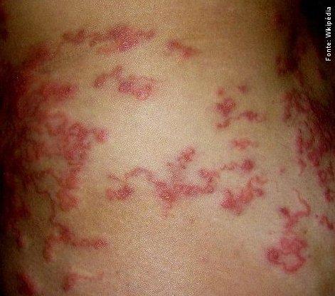 Larva migrans cutânea - Resumo Modo de transmissão: penetração de larvas na pele humana.