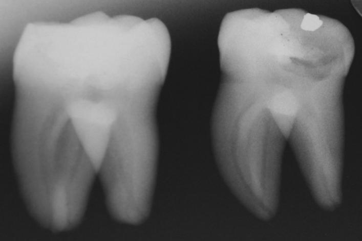4 Critérios de elegibilidade da amostra Critérios de inclusão: Os elementos dentais apresentavam: rizogênese completa; classificação do sistema de canais radiculares em Weine tipo II ou Weine tipo