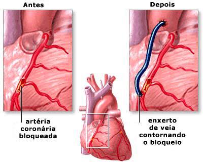 Coronárias: artérias que oxigenam o miocárdio; obstruções