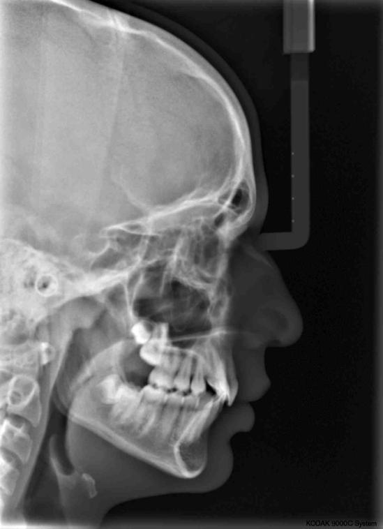 20 A B C D E FIGURA 11 Análise dentária: fotos intra-orais. Lado direito (A), frontal (B), lado esquerdo (C), oclusal superior (D) e oclusal inferior (E).