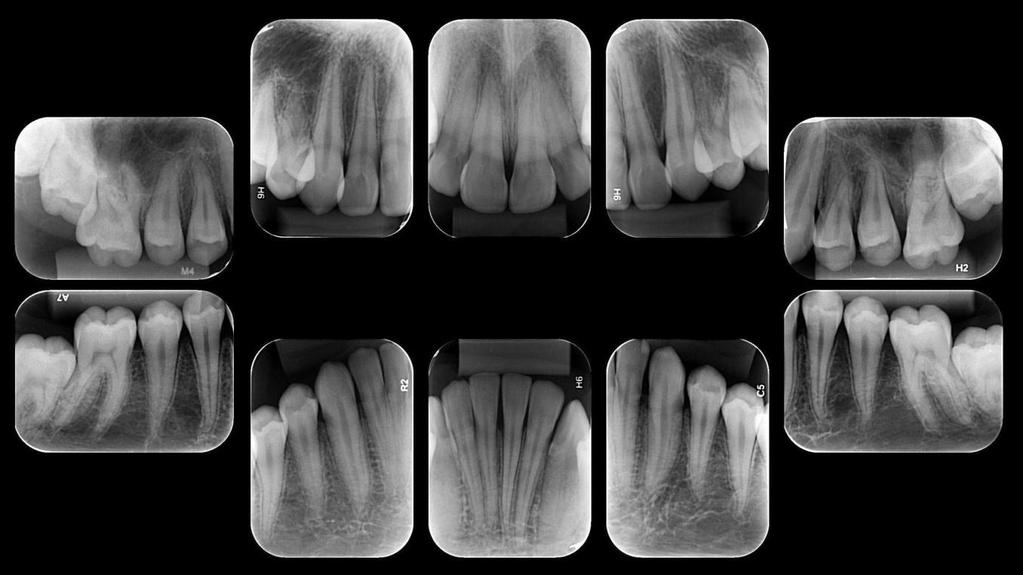 22 FIGURA 14 Radiografias periapicais. 2.2. Plano de tratamento O objetivo do tratamento foi estabelecer a relação de Classe I em molares e caninos, sem prejuízo estético na face.