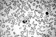 Para classificar uma anemia deve-se observar o tamanho e o conteúdo de hemoglobina do eritrócito, conforme descrito abaixo: TAMANHO Eritrócitos Eritrócitos hipocrômicos e microcíticos Fig.