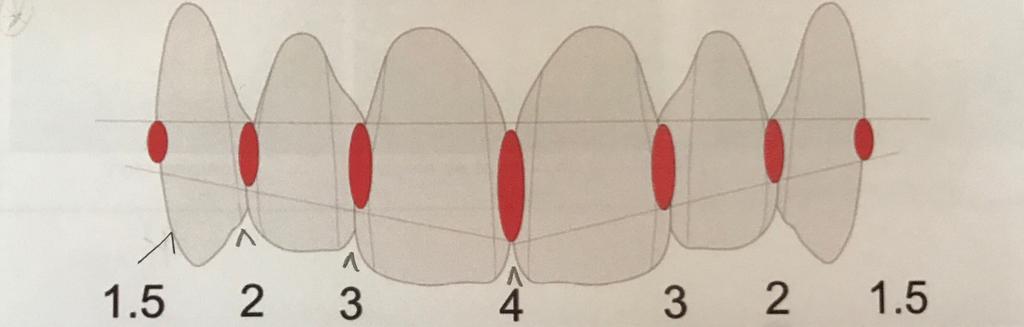 22 Para minimizar ou eliminar formação de triângulos negros ou black spaces, a área de contao deve ser estendida em direção mais cervicalmente possível, por isso, dentes quadrados e, principalmente