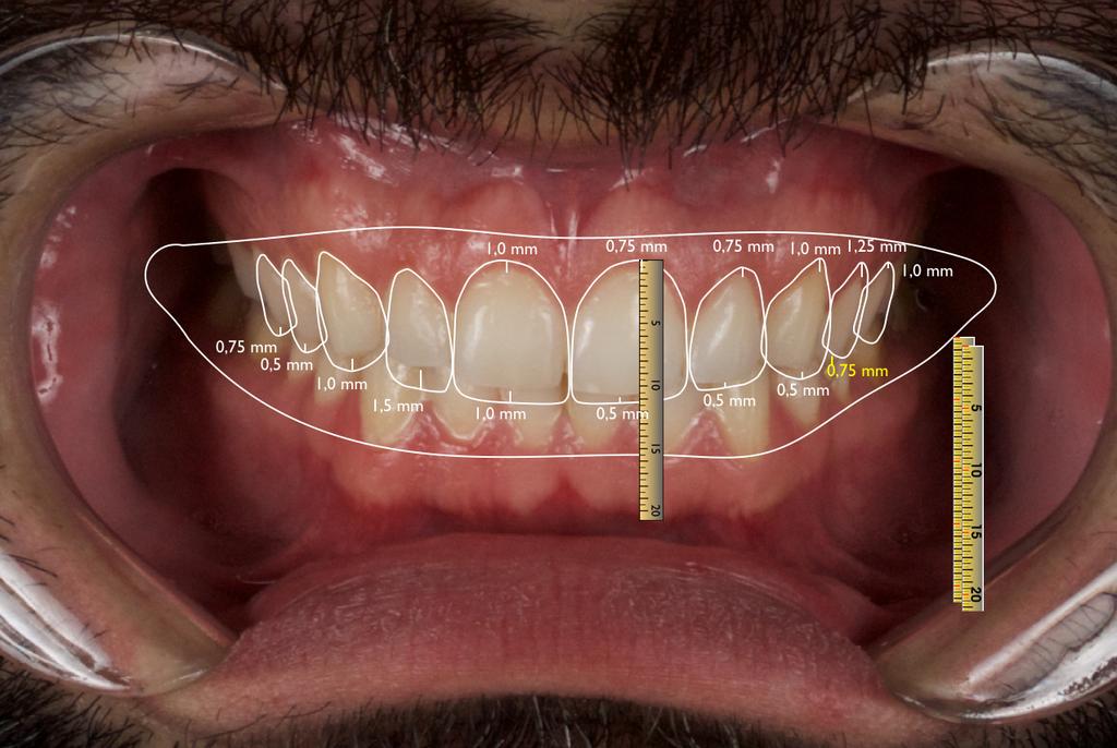 28 dental no slide, permitindo uma análise da proporção atual e uma comparação com a proporção ideal. (Fig.