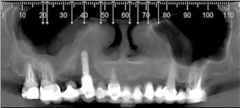 da fossa nasal alcançando as áreas de