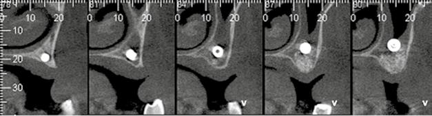 deslocamento do implante para o interior do seio maxilar