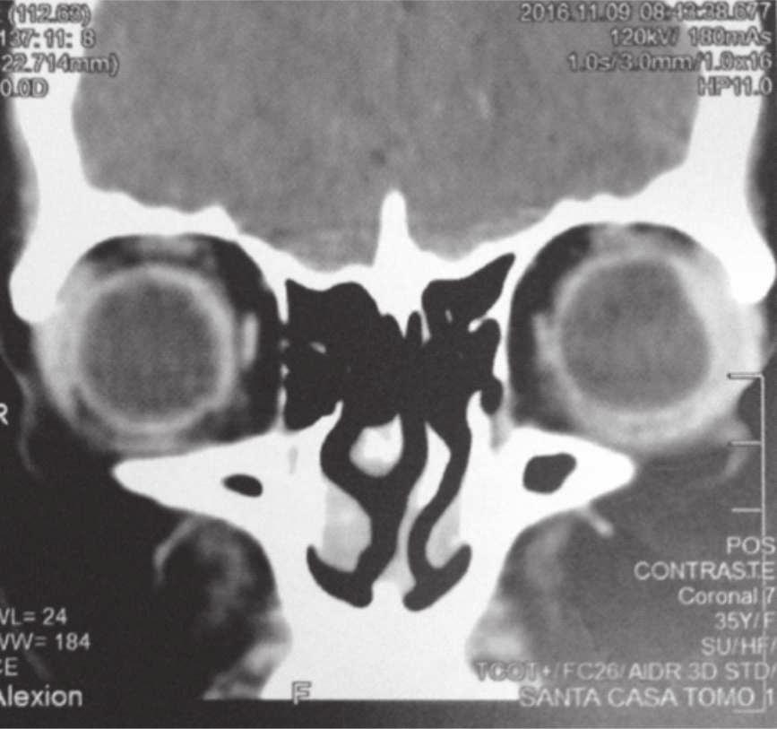 Esclerite posterior bilateral simultânea e unilateral recorrente 39 Introdução Esclerite posterior é uma doença inflamatória ocular que acomete a esclera e muitas vezes é subdiagnosticada, (1) o que