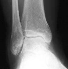 Figura 1. Radiografia do tornozelo de um jogador de futebol, o qual referia dor na região há 1 ano. o início dos sintomas deveu-se a microtraumas repetitivos durante o futebol.