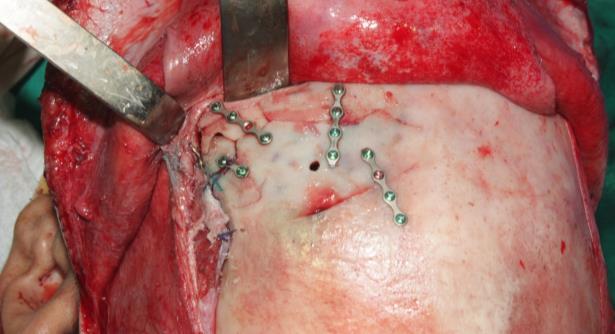 Vista do paciente com afundamento do osso frontal, após incisão e descolamento periosteal, com visão direta da fratura (seta).