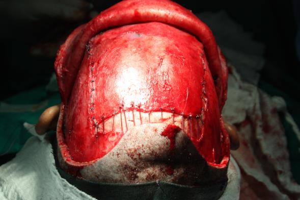 Vista da sutura em pele. Fonte: Serviço de Cirurgia e Traumatologia Bucomaxilofacial do Hospital Universitário do Oeste do Paraná Cascavel PR.