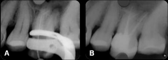 34 Figura 4 Caso clínico 3. A) Radiografia diagnóstica do dente 36. B) Radiografia final do dente 36.