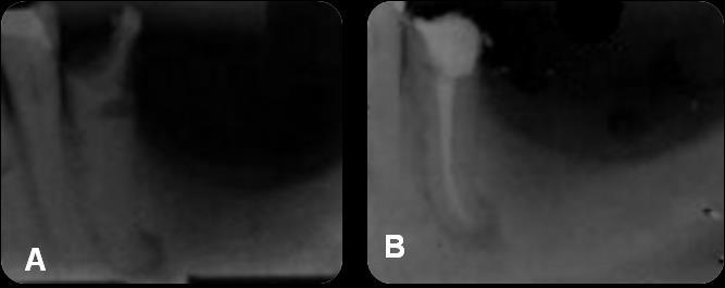 36 Figura 6 Caso clínico 5. A) Radiografia diagnóstica do dente 35. B) Radiografia final do dente 35.