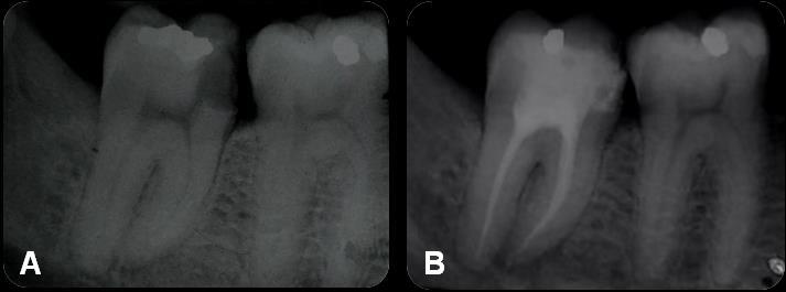 37 o cimento Sealer 26 (Dentsply ) e o selamento com cimento ionômero de vidro Maxxion R A3(FGM ). Figura 7 Caso clínico 6. A) Radiografia diagnóstica do dente 47. B) Radiografia final do dente 47.