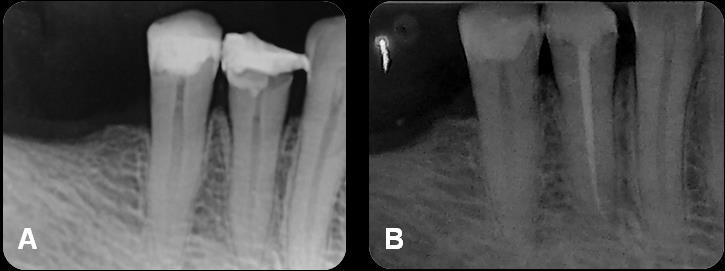 38 Figura 8 Caso clínico 7. A) Radiografia diagnóstica do dente 44. B) Radiografia final do dente 44.