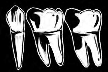 No caso da AFIRMATIVA 3, a superfície PALA- TINA é a superfície da coroa dentária voltada para o PALATO da boca.