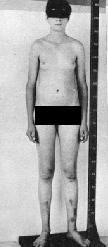 Aneuploidias 2AXXY - Síndrome de Klinefelter. Aspecto masculino. Braços e pernas alongados.