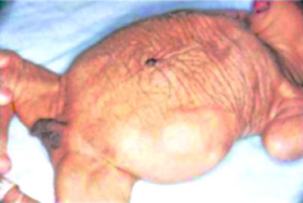 15 Figura 1 - A figura evidencia o abdômen típico da síndrome de Prune Belly em um feto de nosso estudo com 31 semanas pós-concepção. Fonte: <https://www.rrnursingschool.