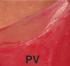 Processus vaginalis Epididymal anomalies Testicular appendices Patency: 72 (66.66%) 27 (69.23%) 49 (73.13%) Occlusion: 36 (33.