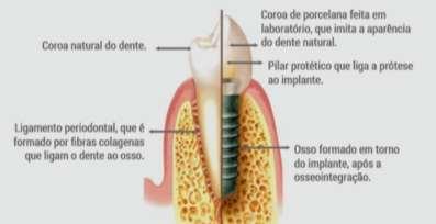 mecânica. Essa configuração geométrica sugerida é simulada via software. A figura 4 mostra os componentes de um implante dentário. Figura 4 Componentes de um Implante dentário.