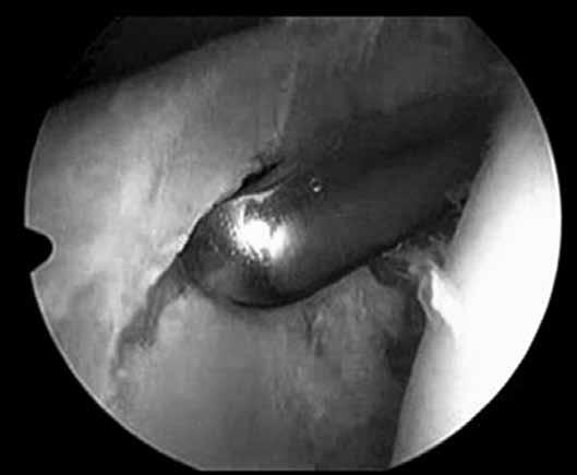 54 A B Figura 2 Imagem artroscópica do ombro direito (visão posterior) mostrando a desinserção do lábio glenoidal superior (A) e após sutura da lesão (B).