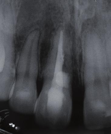 continuidade da reabsorção e mostrava características radiográficas de regressão da reabsorção no elemento dentário (Fig. 4 e 5).