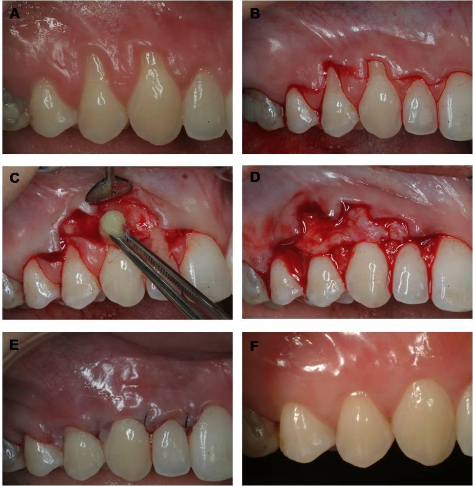 Figura 2 - Técnica cirúrgica: A) Aspecto clínico inicial mostrando recessões múltiplas adjacentes afetando os dentes 13 e 14; B) Incisões submarginais oblíquas nas áreas interdentais unidas por