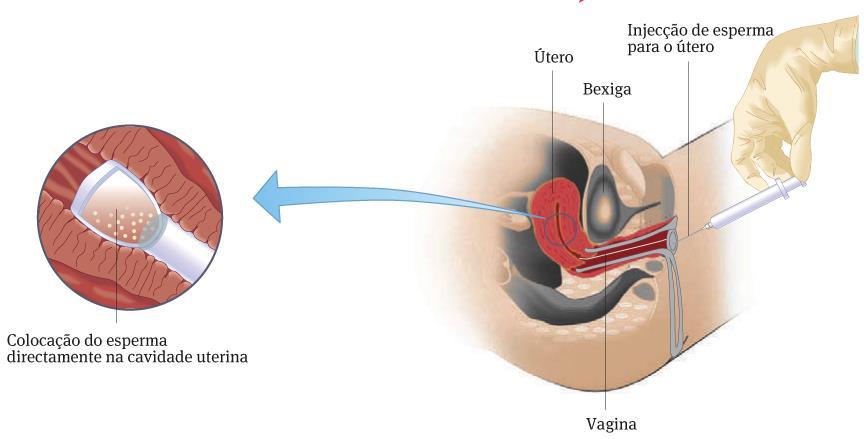 Manipulação da fertilidade Reprodução tecnicamente assistida