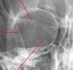 Infra-orbital Fissura orbitaria superior: N. Oculomotor N.