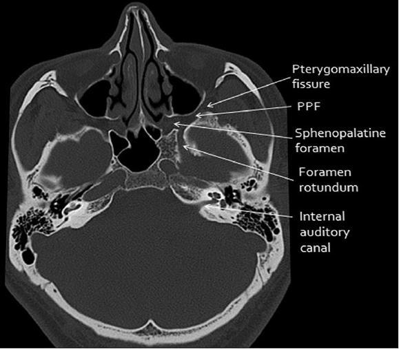 cranianas