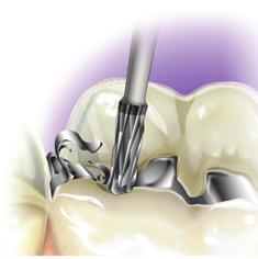 face oclusal dos dentes posteriores.