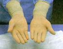 2 Luvas cirúrgicas estéreis (procedimentos críticos): Embaladas em envelopes individuais em pares, os punhos são mais longos e elas serão calçadas após anti-sepsia das mãos e colocação do avental