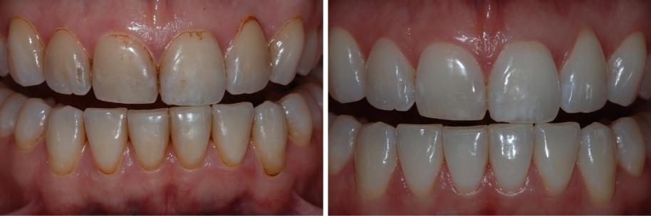 Efeitos colaterais CHX 1. Pigmentação de dentes, restaurações e mucosas 2. Distúrbios reversíveis do paladar 3.